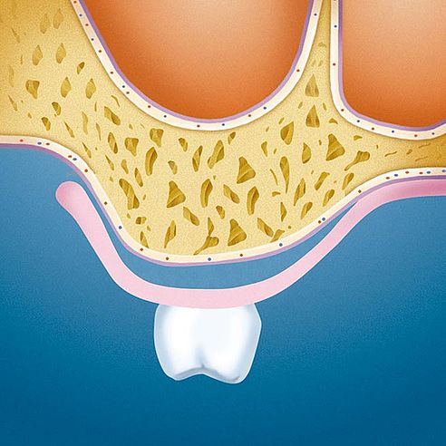 Zubní náhrada během přechodného období (dutiny mezi čelistním výběžkem a dočasnou zubní náhradou) | Protefix